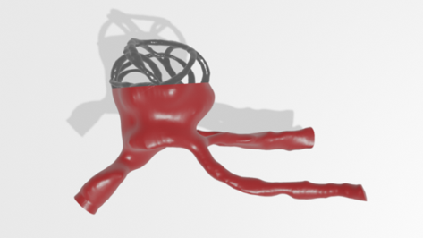Darstellung eines CAD-Modells eines patientenspezifischen Aneurysmas mit Implantat